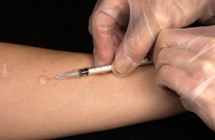 mantoux-tuberculin-skin-test-728x728.jpg
