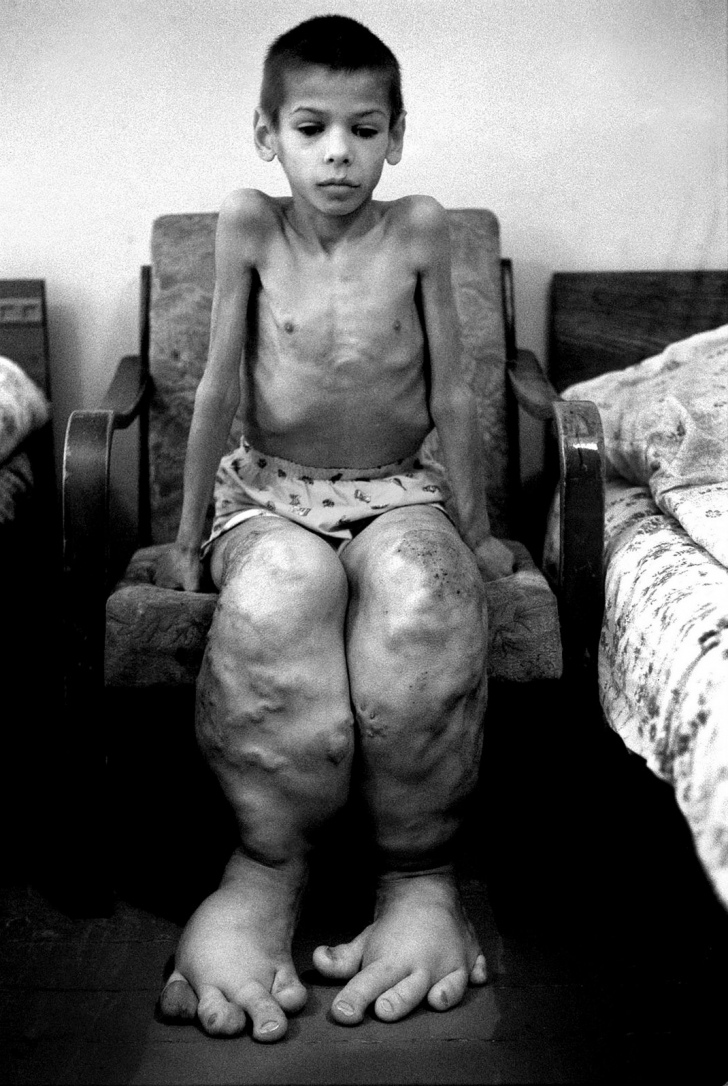 birth-defects-chernobyl-728x728.jpg